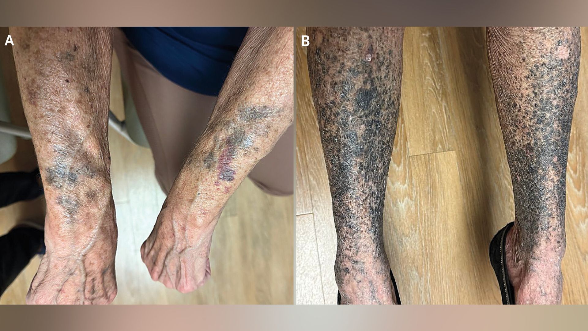 İlaç Sonrası Şok: 68 Yaşındaki Kadın Haftalar İçinde "Mavi-Siyaha" Dönüştü